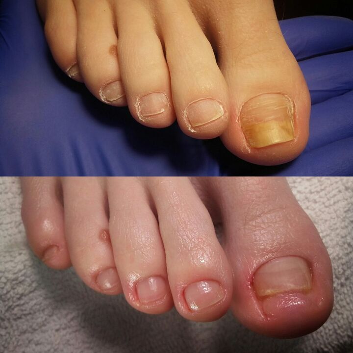 Before and after applying Exodermin Yesenia cream