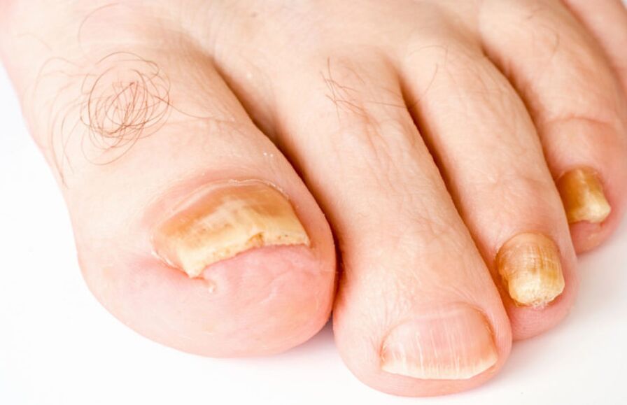 foot fungus symptoms