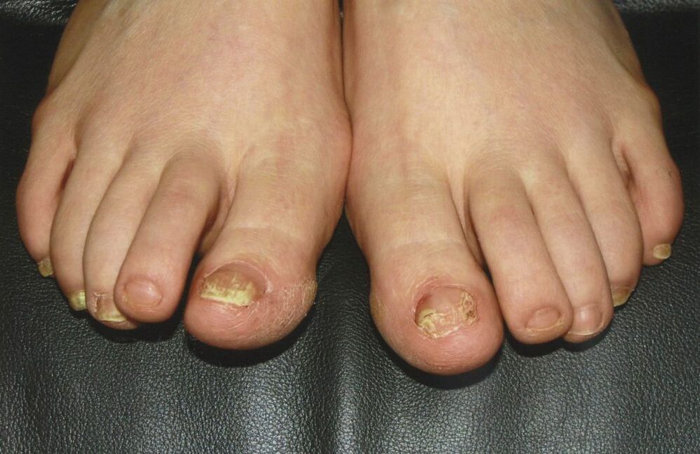 fungal toenails