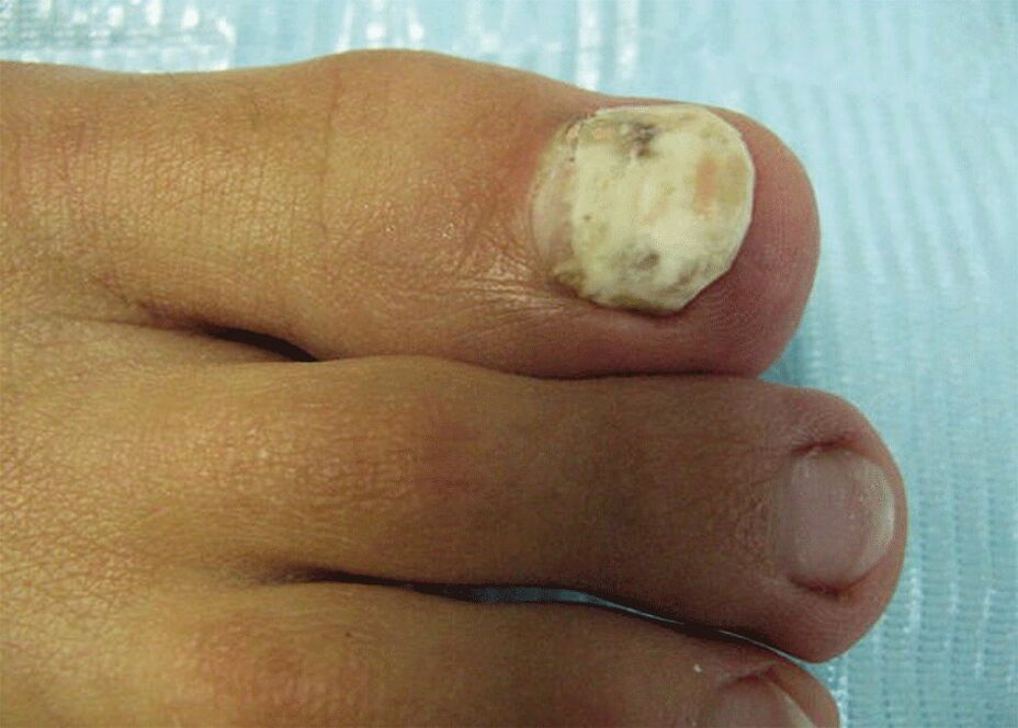 damage to the nail plate by fungus