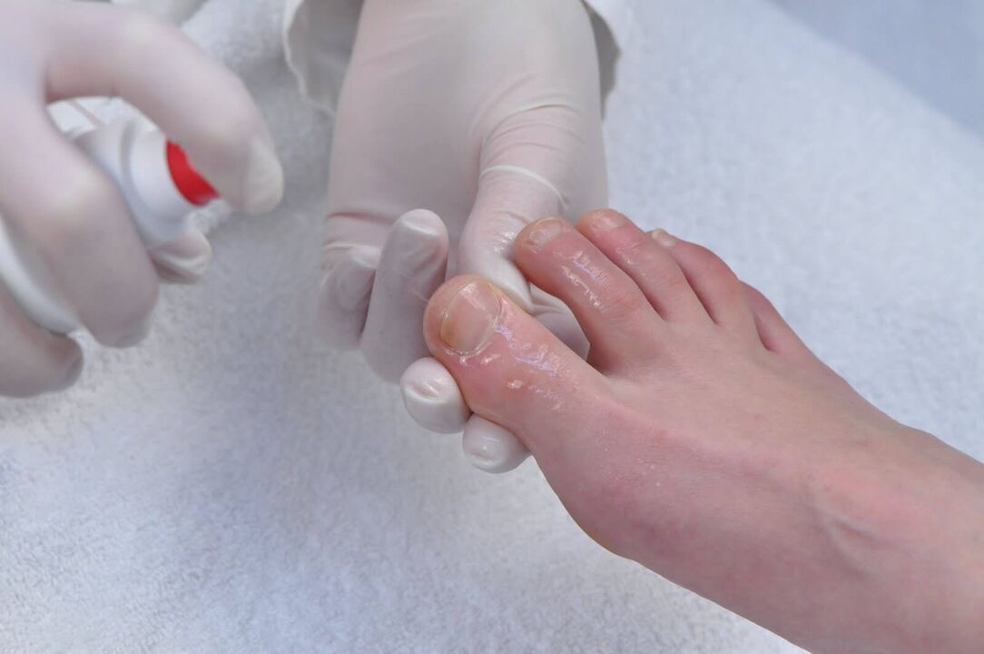 The initial stage of onychomycosis is the reason for a diagnostic examination by a dermatologist