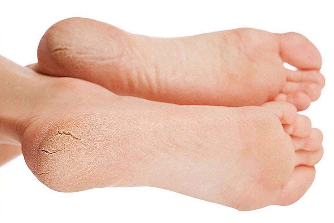 fungal infections of the feet