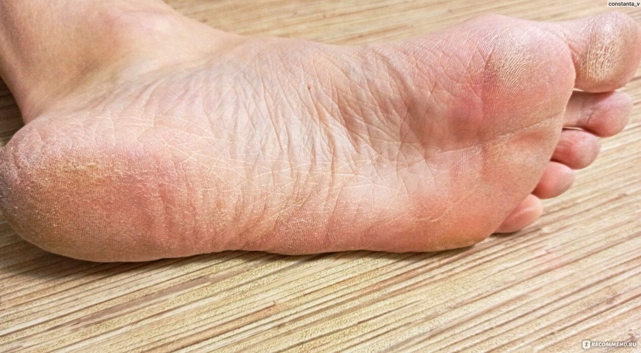 fungus on the human foot